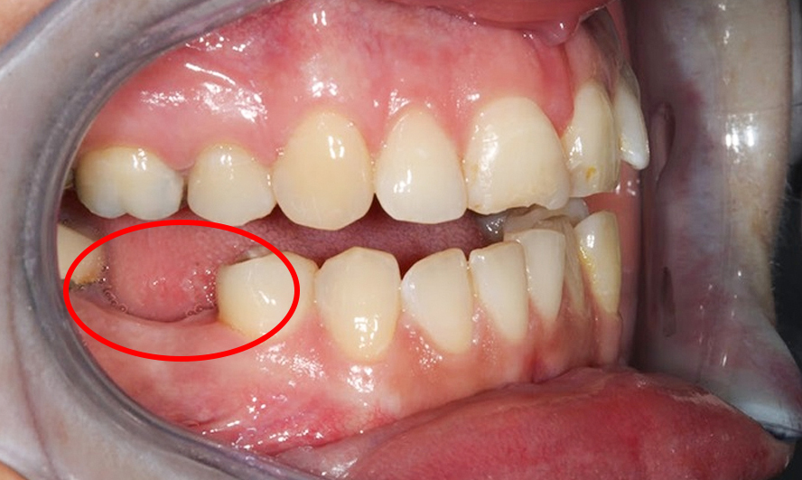 Mất răng 6 trong cung hàm có thể gây ra 1 loạt các hệ lụy, để càng lâu càng dễ mất thêm nhiều răng