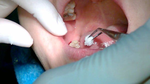 Tại sao nhổ răng khôn có thể bị sưng, đau?