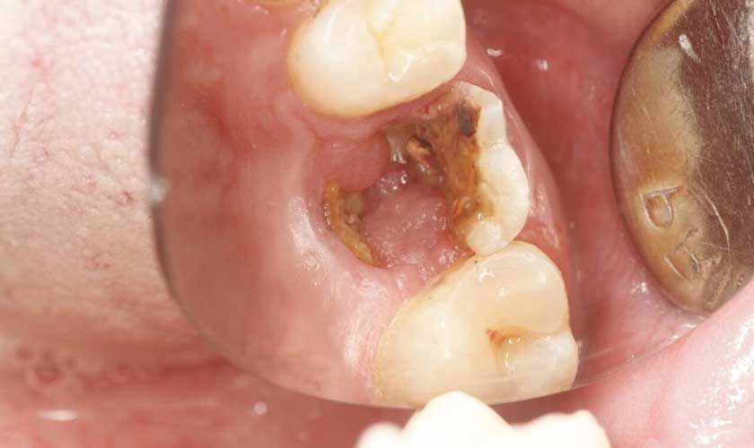 5 dấu hiệu răng sâu đã vào tủy – nhận biết để cứu răng kịp thời