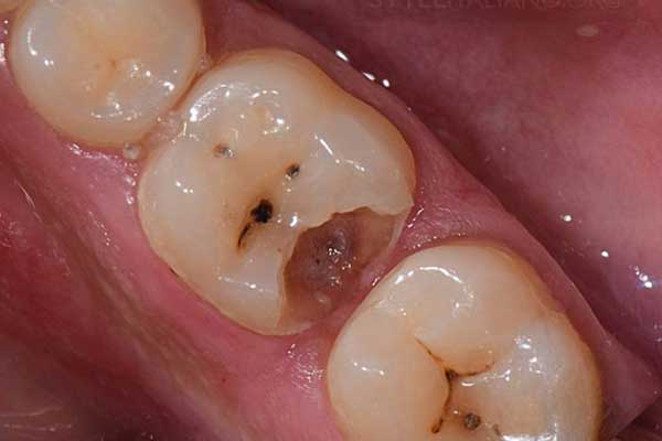 Nếu đã sâu tủy, nha khoa sẽ làm gì?