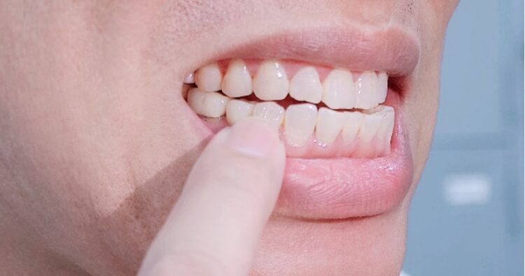 Ảnh trong miệng thực tế chiếc răng 5 trồng Implant của ThS BS Phạm Hùng Sơn