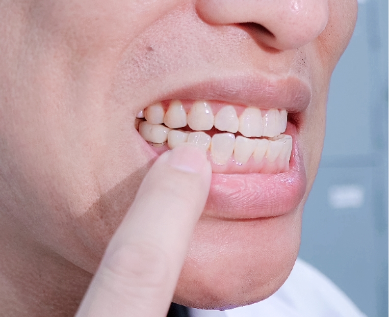 Ảnh trong miệng thực tế chiếc răng 5 trồng Implant của ThS BS Phạm Hùng Sơn