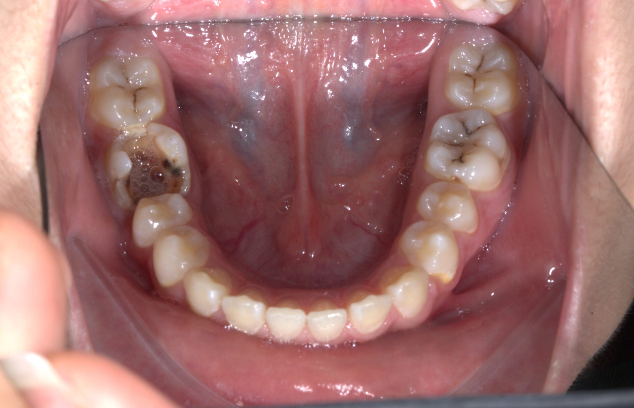 Răng 6 mất ảnh hưởng rất nghiêm trọng đến khớp cắn trong tương lai của trẻ