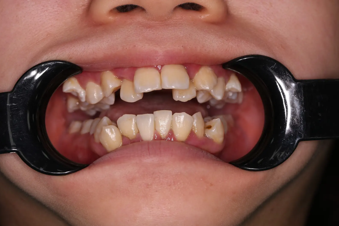 Răng con khấp khấp là điều bố mẹ cần chú ý vì rất khó vệ sinh