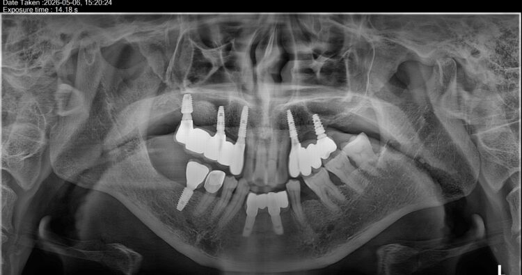 Lắp răng hoàn thiện sau 1 hành trình điều trị dài