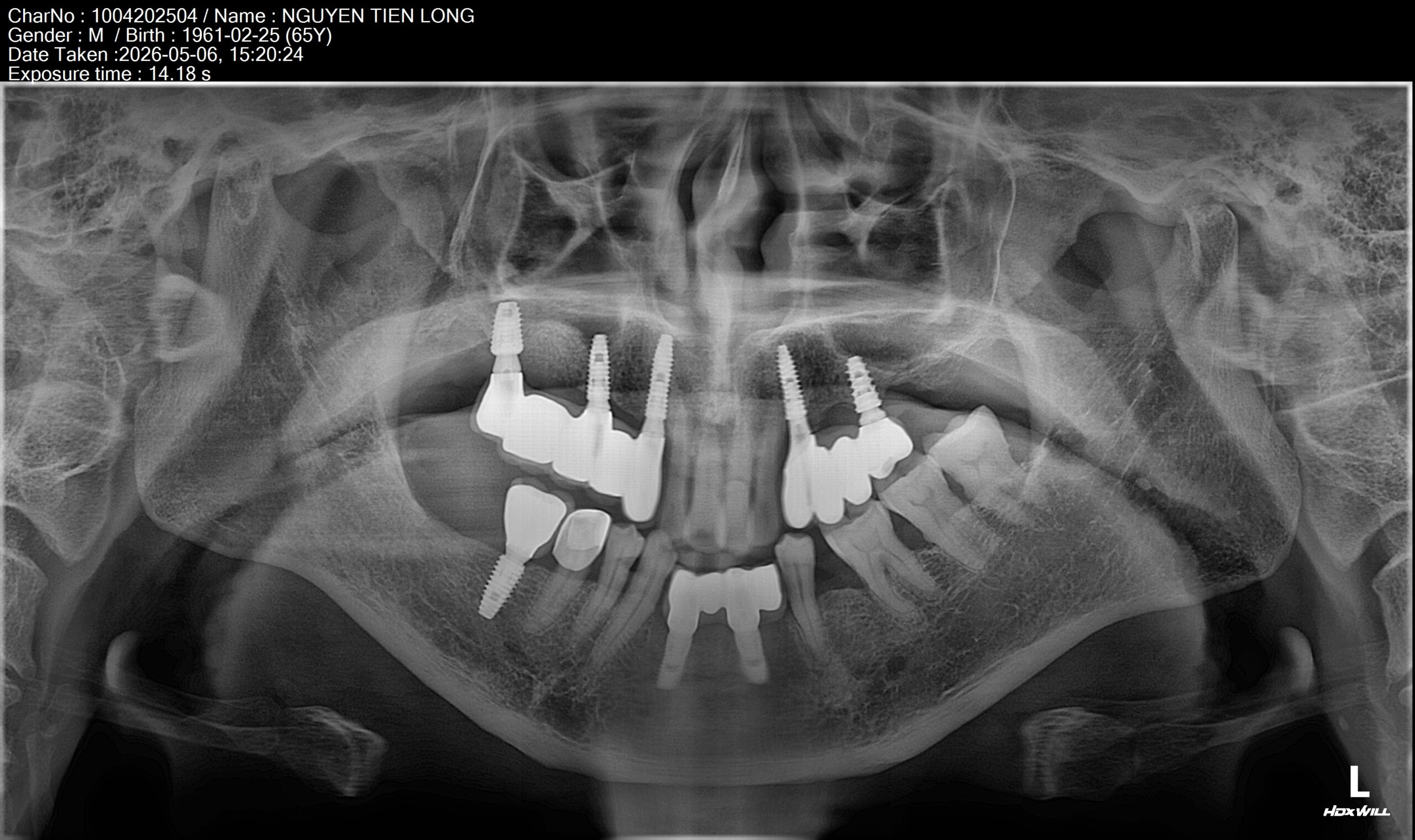 Lắp răng hoàn thiện sau 1 hành trình điều trị dài