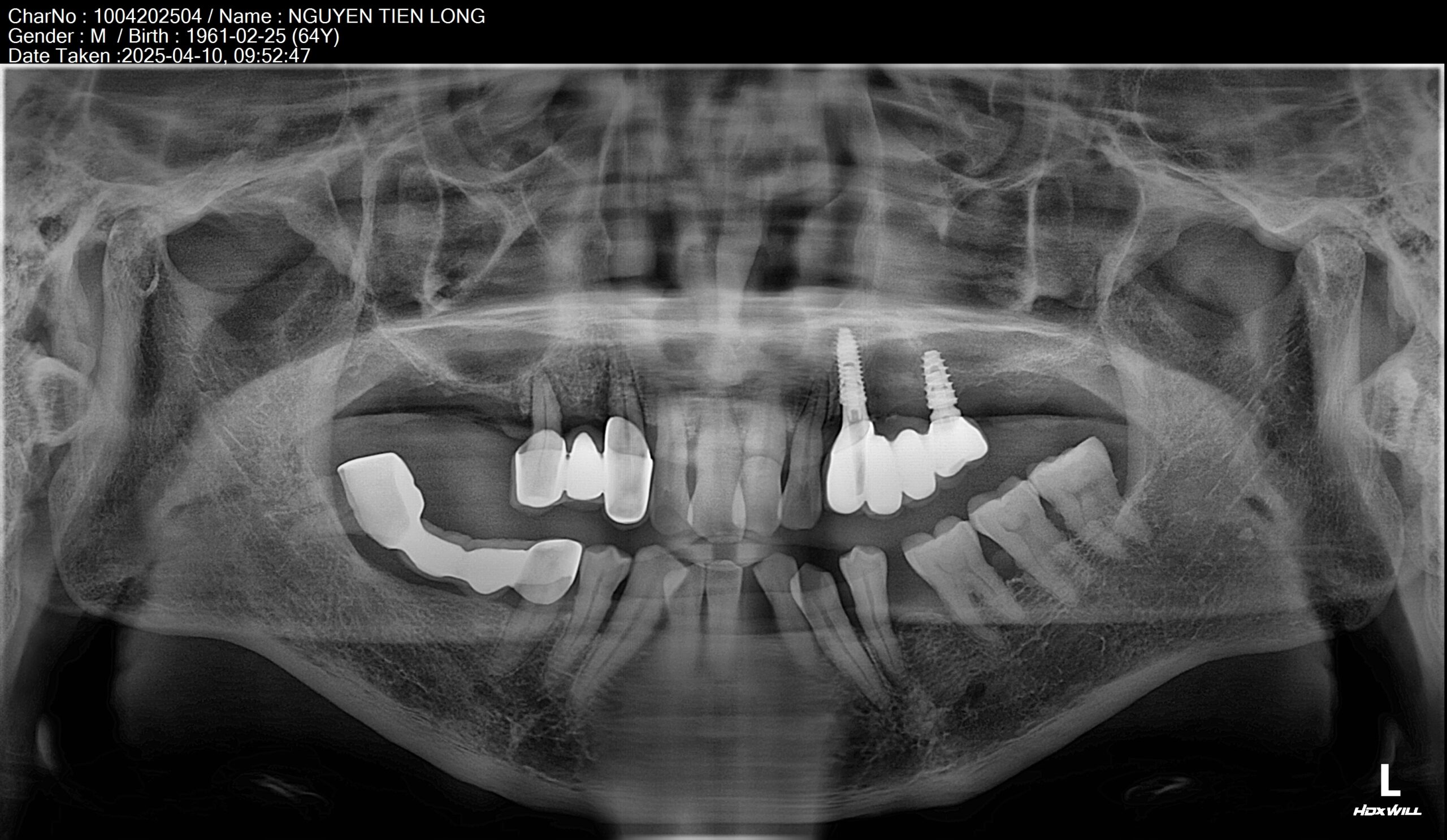 Chú Long đã từng cấy Implant ở 1 bên khác nhưng rồi bỏ không làm nữa