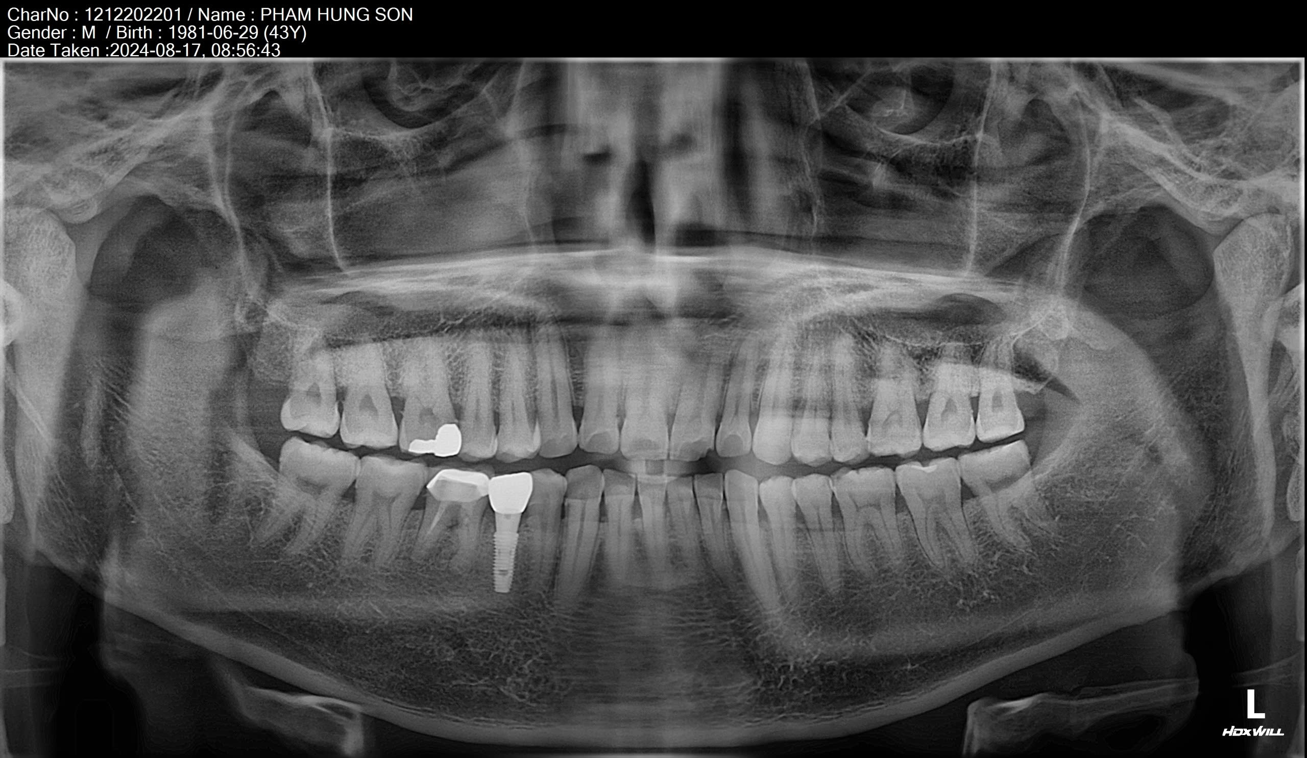 X-Quang răng của ThS BS Phạm Hùng Sơn