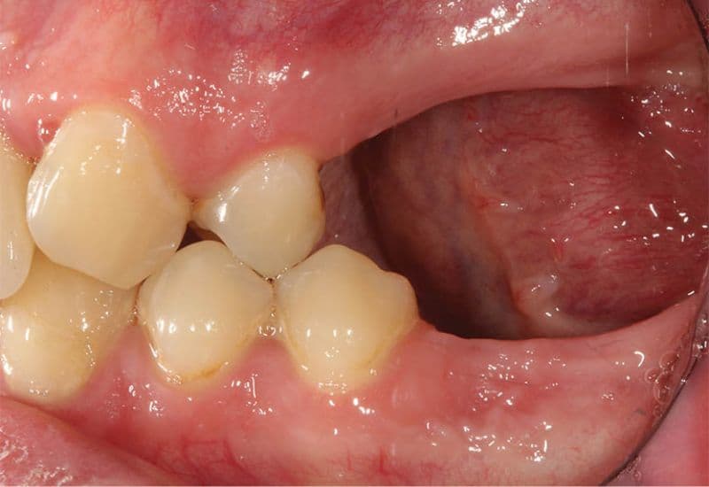 Mất răng lâu tiêu xương việc xử lý nền xương là cần thiết