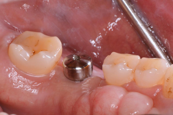 Mô mềm lợi nướu là hàng rào bảo vệ Implant đầu tiên