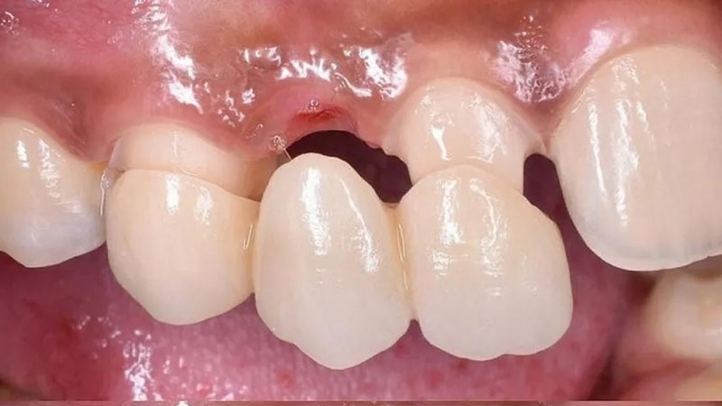 Cầu răng sứ là gì? Vì sao nó có thể gây hôi miệng?