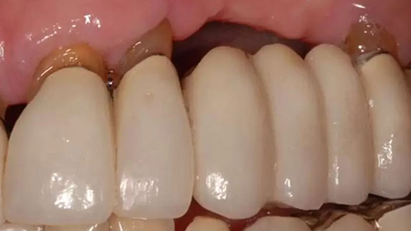 Những phiền toái hàng ngày: Khi cầu răng sứ trở thành "ổ vi khuẩn"