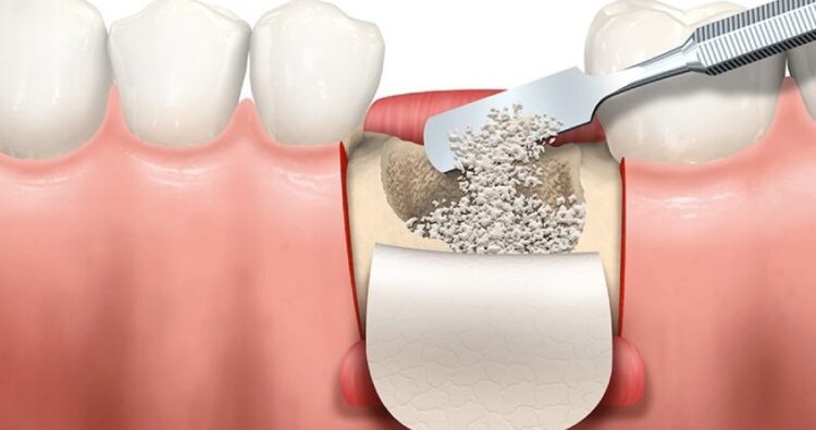 Tại sao thời gian chờ sau ghép xương lại khác nhau? – Giải mã sự khác biệt giữa các nha khoa Tại sao thời gian chờ sau ghép xương lại khác nhau? – Giải mã sự khác biệt giữa các nha khoa