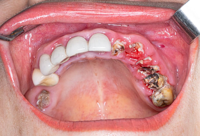 Những chiếc răng trụ bị "mủn" đi đáng kể